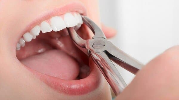 Tại sao bạn lại nằm mơ thấy rụng răng? Một số nguyên nhân có thể dẫn đến giấc mơ rụng răng